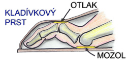 Kladívkový prst, mozol a otlak